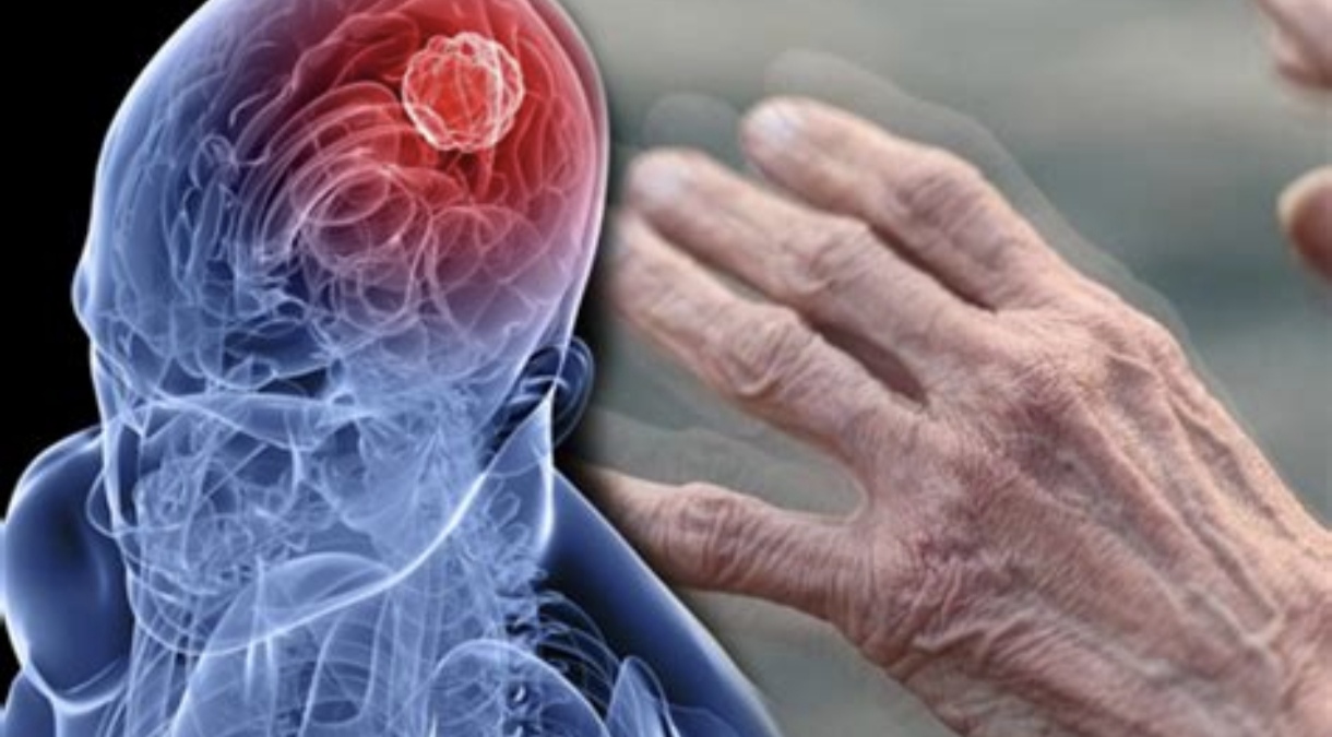 11 Aprel – Ümumdünya Parkinson Xəstəliyi ilə Mübarizə Günü qeyd olunur