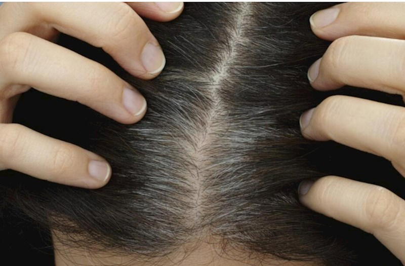Saçların vaxtından tez ağarımasının səbəbləri