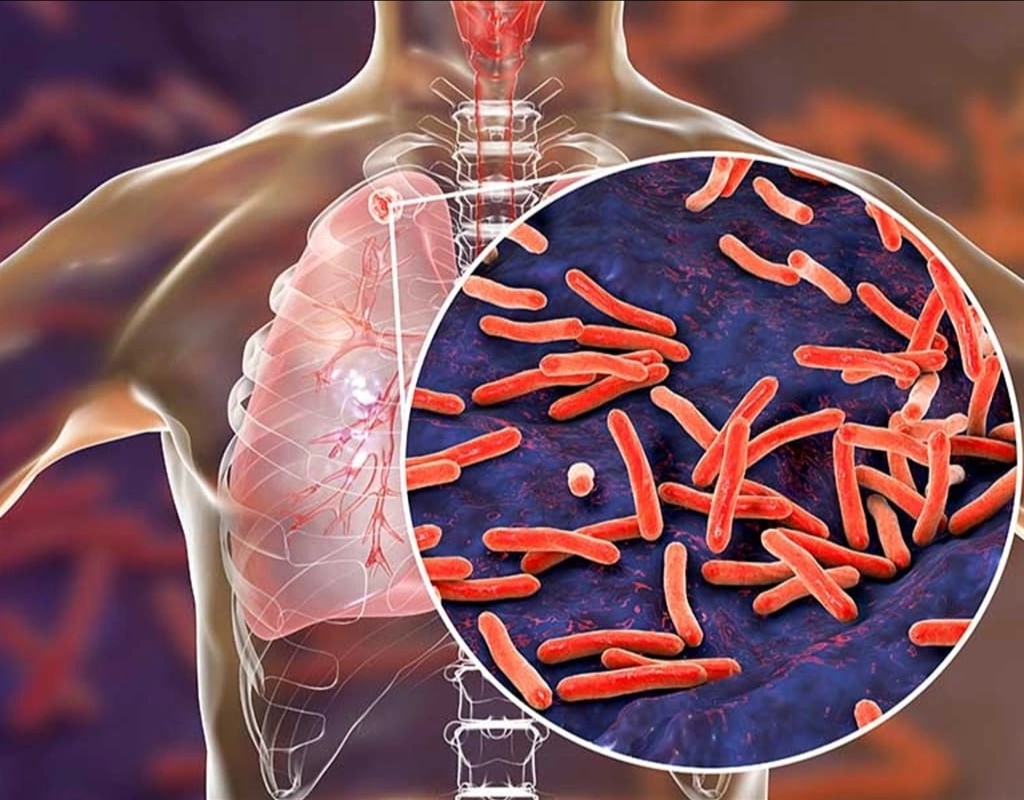Vərəmə yoluxma halları son 15 ildə əhəmiyyətli dərəcədə azalıb