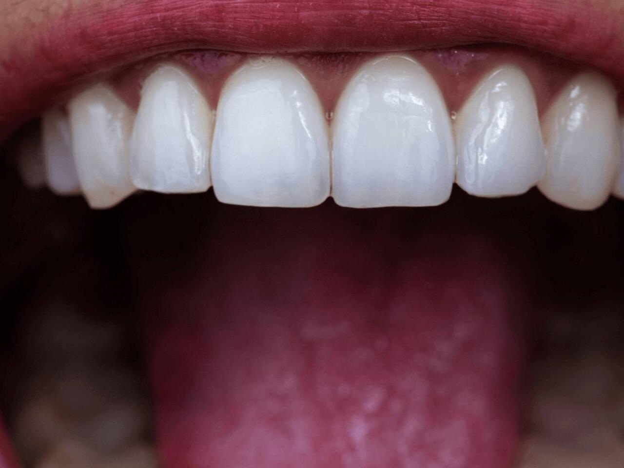 Daimi stresin dişlərə zərərli təsirləri