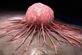 Alimlərdən inqilabi addım: Beyindəki şişlərə qarşı yeni metod