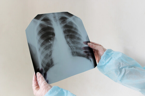 Dünyada təxminən iki milyard insan gizli vərəmə yoluxub