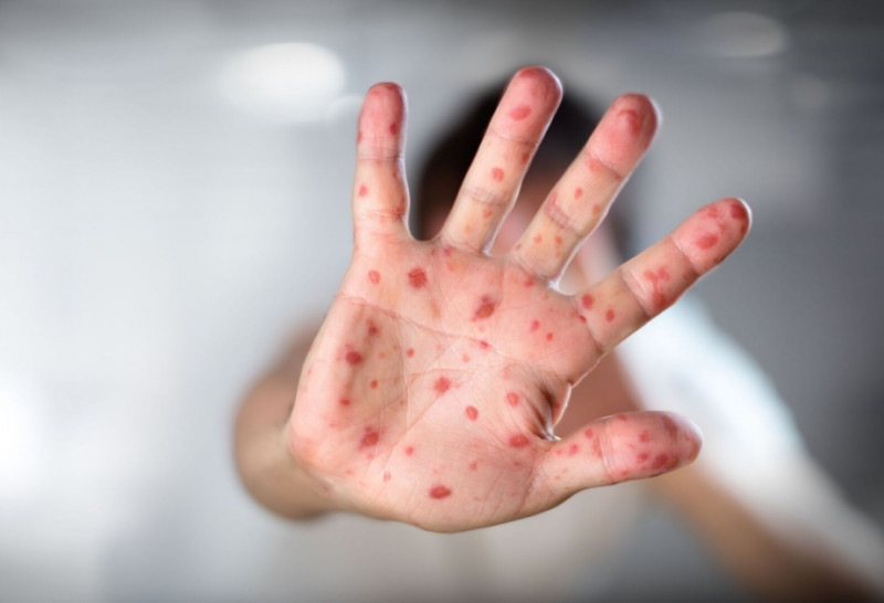 Onlar risk altındadır, qızılca peyvəndinin vaxtı önə çəkilməlidir - Həkimdən təklif